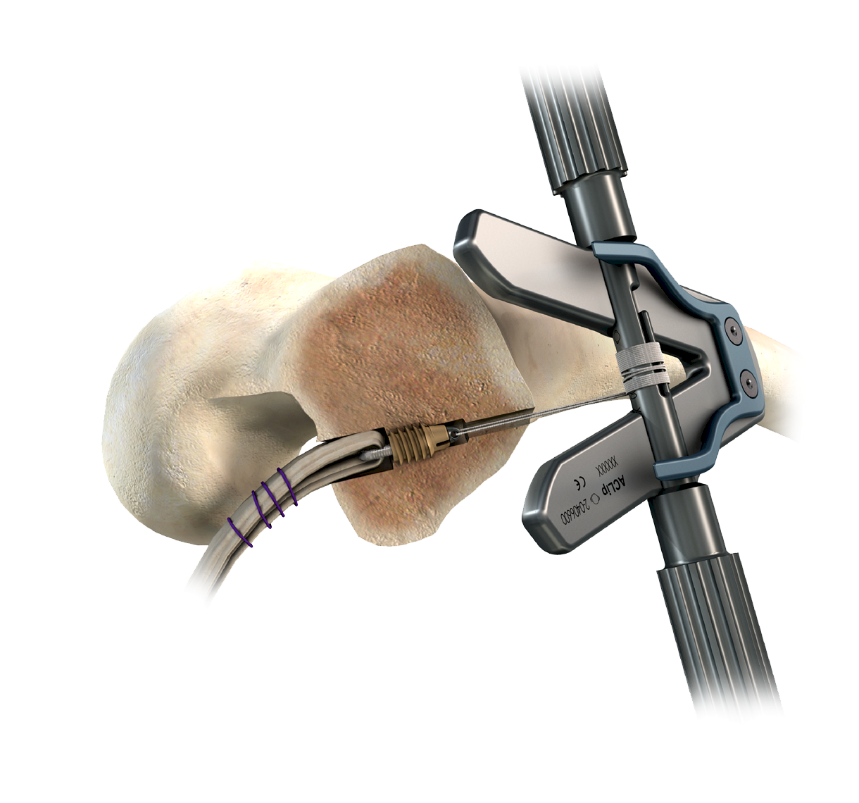 ACLip Femoral-6