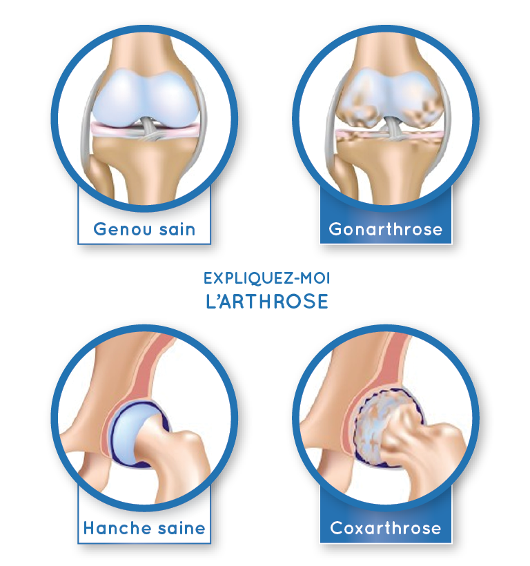 Explication arthrose